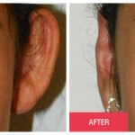 austin otoplasty results young woman
