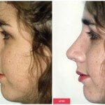 austin rhinoplasty side view before after