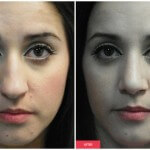 nose job procedure results austin woman