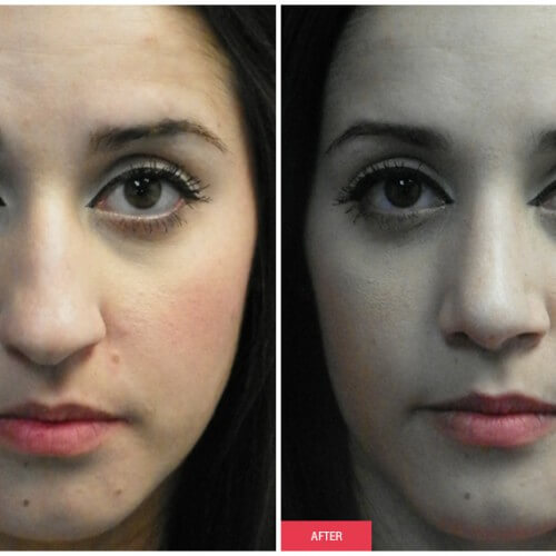 nose job procedure results austin woman.