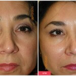 austin injectables patient results
