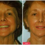 austin face lift before and after treatment