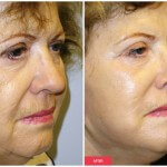 austin face lift procedure results