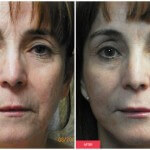 austin woman cosmetic treatment before after