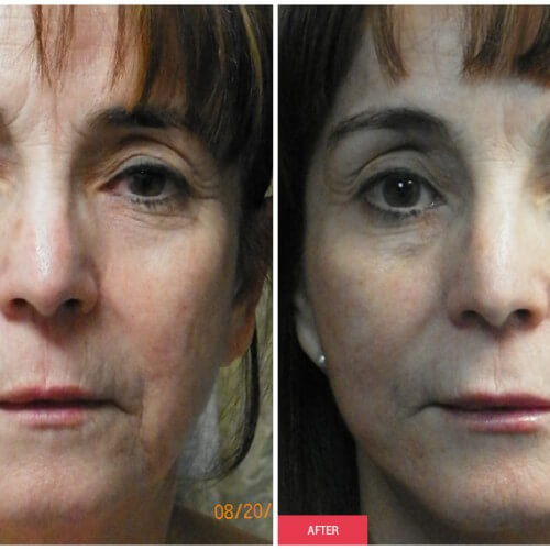 Austin Facelift Surgery | Rhytidectomy [Dr. Bittar]