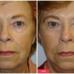 austin woman cosmetic surgery results