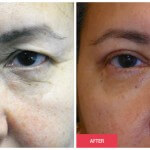before after eyelid surgery