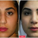 nose job procedure results photos young woman