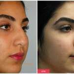 austin nose job results young woman
