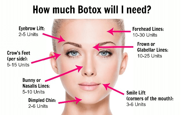 how much botox is needed chart