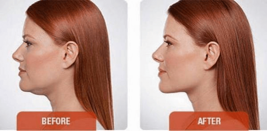 austin kybella treatment double chin results female model
