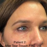 woman after tear trough filler injectable
