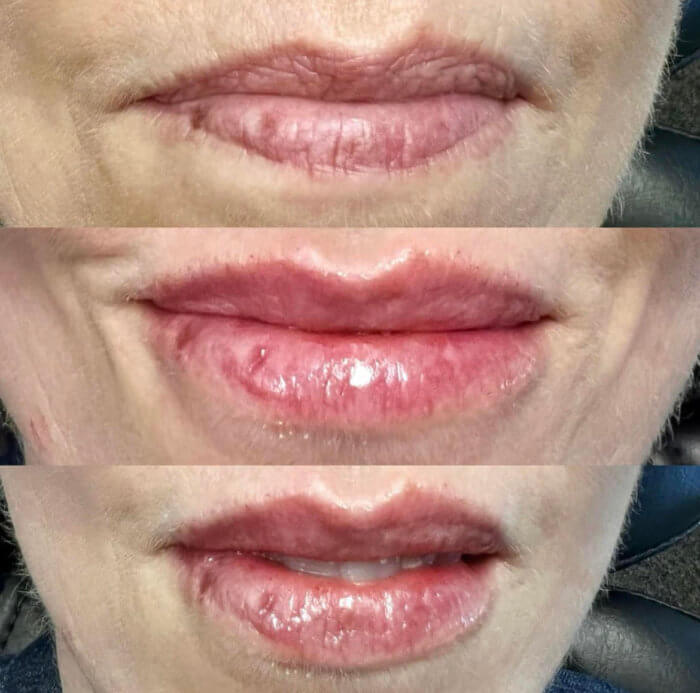 Before & After Lip Injections Gallery Dr. Anthony Bittar